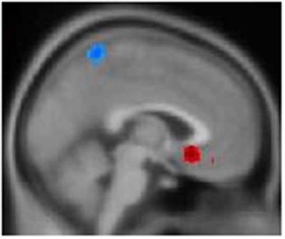 Gray Matter Volume and Functional Connectivity in Hypochondriasis: A Magnetic Resonance Imaging and Support Vector Machine Analysis